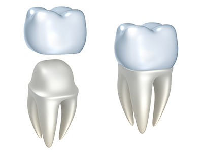 Dental Crown - Dentist Vancouver, WA Dental Crown - Dentist Vancouver, WA